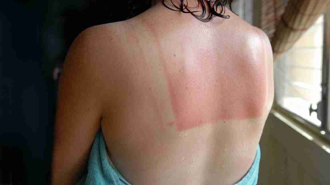 image of someone's back with square-shaped sunburn