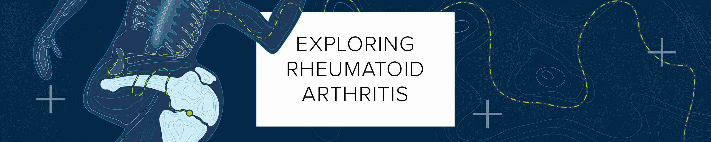 Exploring Rheumatoid Arthritis