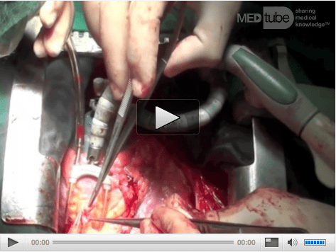 Off Pump Coronary Artery Bypass Grafting